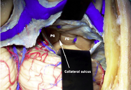 DrBaskaya's tweet photo. Access to the #atrium of lateral #ventricle lesions via #Supracerebellar transtentorial #transcollateral sulcus #approach
https://t.co/J4AzPkmWvj
@uw_neurosurgery @UWHealth @uwsmph @ElsevierConnect @sciencedirect
#skullbase #neuroanatomy #nsgy #microsurgery #Technique #training https://t.co/jwbcpTGD9K