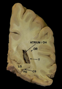 DrBaskaya's tweet photo. Access to the #atrium of lateral #ventricle lesions via #Supracerebellar transtentorial #transcollateral sulcus #approach
https://t.co/J4AzPkmWvj
@uw_neurosurgery @UWHealth @uwsmph @ElsevierConnect @sciencedirect
#skullbase #neuroanatomy #nsgy #microsurgery #Technique #training https://t.co/jwbcpTGD9K