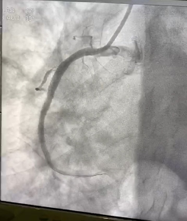 مركز القلب بمستشفى الملك فهد التخصصي بتبوك يعتبر احد المراكز القلبيه المتقدمه فى مملكتنا الحبيبه وتم افتتاحه فى منتصف عام 2016..فقد قام اليوم هذا المركز بعمل قسطره حرجه لإنقاذ مريض من ذبحه صدريه بإخراج الخثرات من داخل الشريان ووضع دعامه...
#تبوك
#السعوديه
#الصحه
#اطباء
#القلب