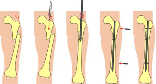 Нужно ли снимать пластины. Внутрикостный остеосинтез. Интрамедуллярный (внутрикостный) остеосинтез. Внутрикостный остеосинтез диафиза бедренной кости. Остеосинтез бедренной кости операция.