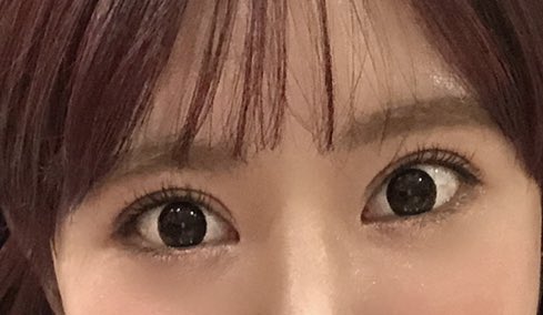 busu8123's tweet photo. 12月末で術後6か月だた！
脂肪移植2次と人中もして面長改善されて顔が若々しくなった♪おでこの脂肪移植あまり定着しなかったのが残念…
二重は日に日に腫れが落ち着いてきてるけど左目はまだソーセージって感じ😭
鼻は2、3か月目から特に変化なし！
大満足💓
#CLASSY美容外科 https://t.co/phHhYk56Yr