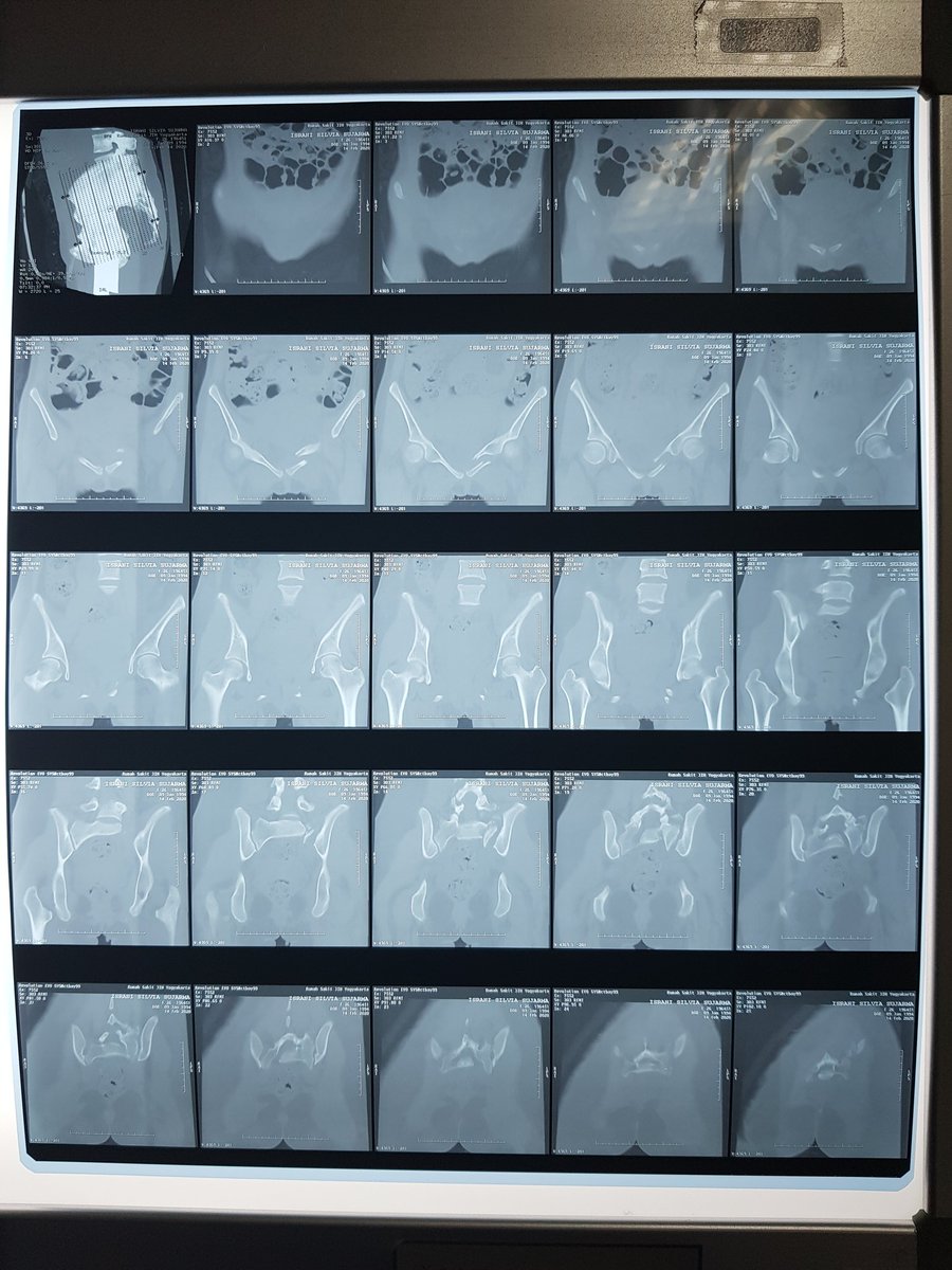 Sampai saat ini masih ada dana yang masih menggantung dari RS PKU JOGJA dan istri saya masih di rawat di RS JIH yang belum dapat ditentukan sampainkapan harus dirawat di RS JIH