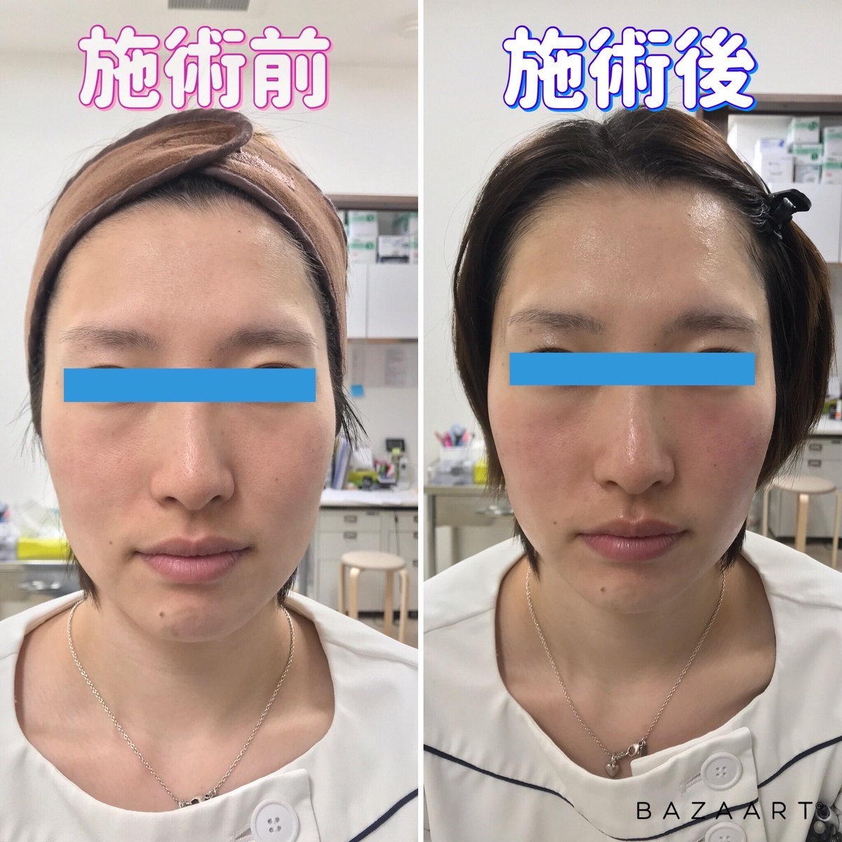 みずほクリニック ペレヴェの施術前後の写真です フェイスラインがスッキリ 口元のもたつきの改善 全体的な血色のup その他に この写真では確認できませんが目の開きも良くなりスッキリとした印象になりました 目元のみの施術も可能です 料金 みずほクリニック ペレヴェの施術前後の写真です フェイスラインがスッキリ 口元のもたつきの改善 全体的な血色のup その他に この写真では確認できませんが目の開きも良くなりスッキリとした印象になりました 目元のみの施術も可能です 料金