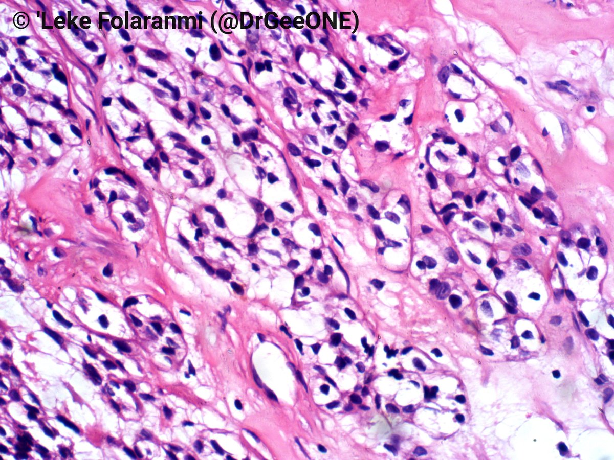 Olaleke Folaranmi (@drgeeone) on Twitter photo Huge mass in the palate of a middle aged man.
No IHC support!😣
I'm voting for hyalinizing clear cell carcinoma.
Who's with me?🥰
Who's not?😆💝
<a href="/thisisAziz/">Aziz</a> <a href="/nusrat_xahra/">🔻Nusrat Zahra🔻🇵🇸</a> <a href="/AMubeen_Path/">Aysha Mubeen</a> <a href="/vi_monappa/">Vidya Monappa</a> <a href="/padmapathology1/">Padma Priya J</a> <a href="/MAHoureih/">M Adib Houreih, M.D, DipRCPath محمد أديب حورية</a>
<a href="/PathologySayah/">Maryam Sayah, MD</a> #OralPath #HNPath #ENTpath Huge mass in the palate of a middle aged man.
No IHC support!😣
I'm voting for hyalinizing clear cell carcinoma.
Who's with me?🥰
Who's not?😆💝
<a href="/thisisAziz/">Aziz</a> <a href="/nusrat_xahra/">🔻Nusrat Zahra🔻🇵🇸</a> <a href="/AMubeen_Path/">Aysha Mubeen</a> <a href="/vi_monappa/">Vidya Monappa</a> <a href="/padmapathology1/">Padma Priya J</a> <a href="/MAHoureih/">M Adib Houreih, M.D, DipRCPath محمد أديب حورية</a>
<a href="/PathologySayah/">Maryam Sayah, MD</a> #OralPath #HNPath #ENTpath