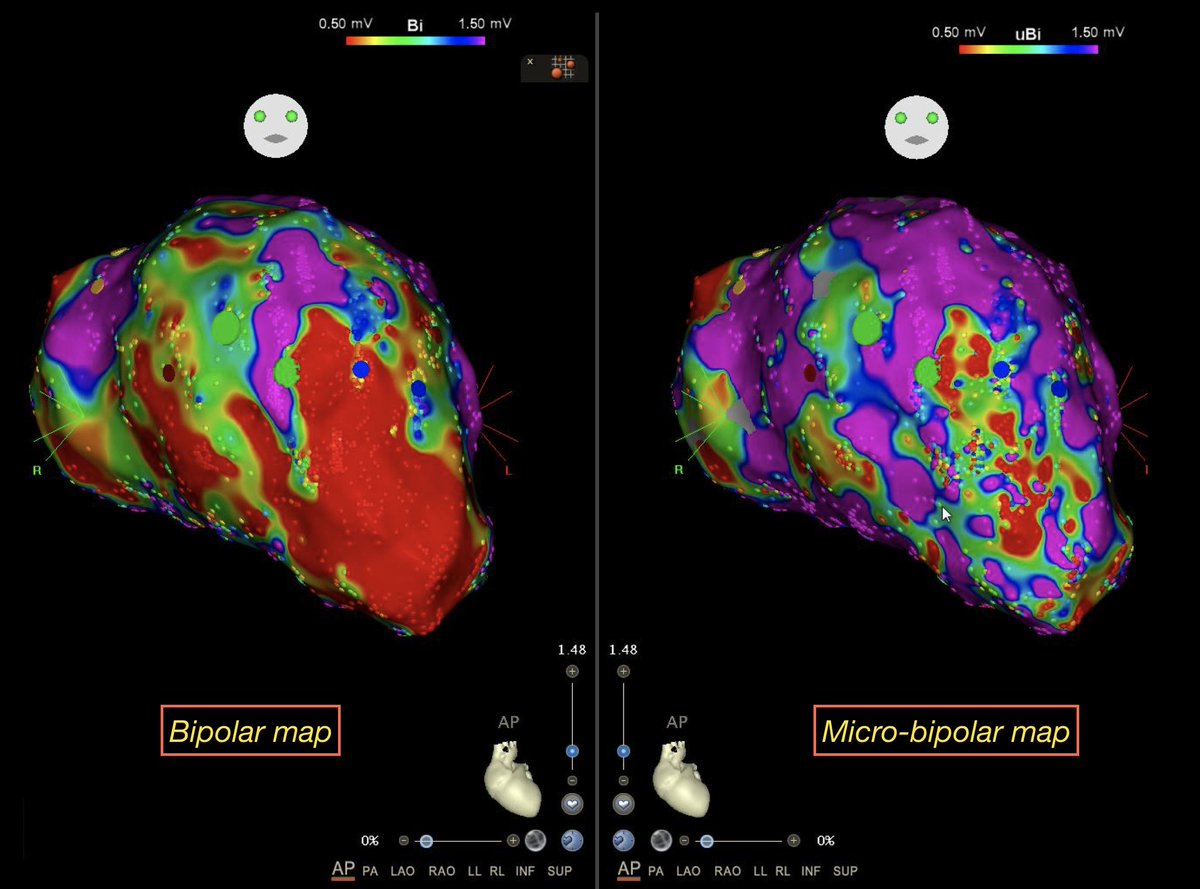 sozi81's tweet image. Our first experience with #QDOT in RVOT #VPB and #VT ablation. Images already speak for themselves. We were used to depict big phenomena, now we can see little things happening. The future is in #microelectrodes. Congrats to 
@BiosenseWebster for this huge innovation in CardiacEP