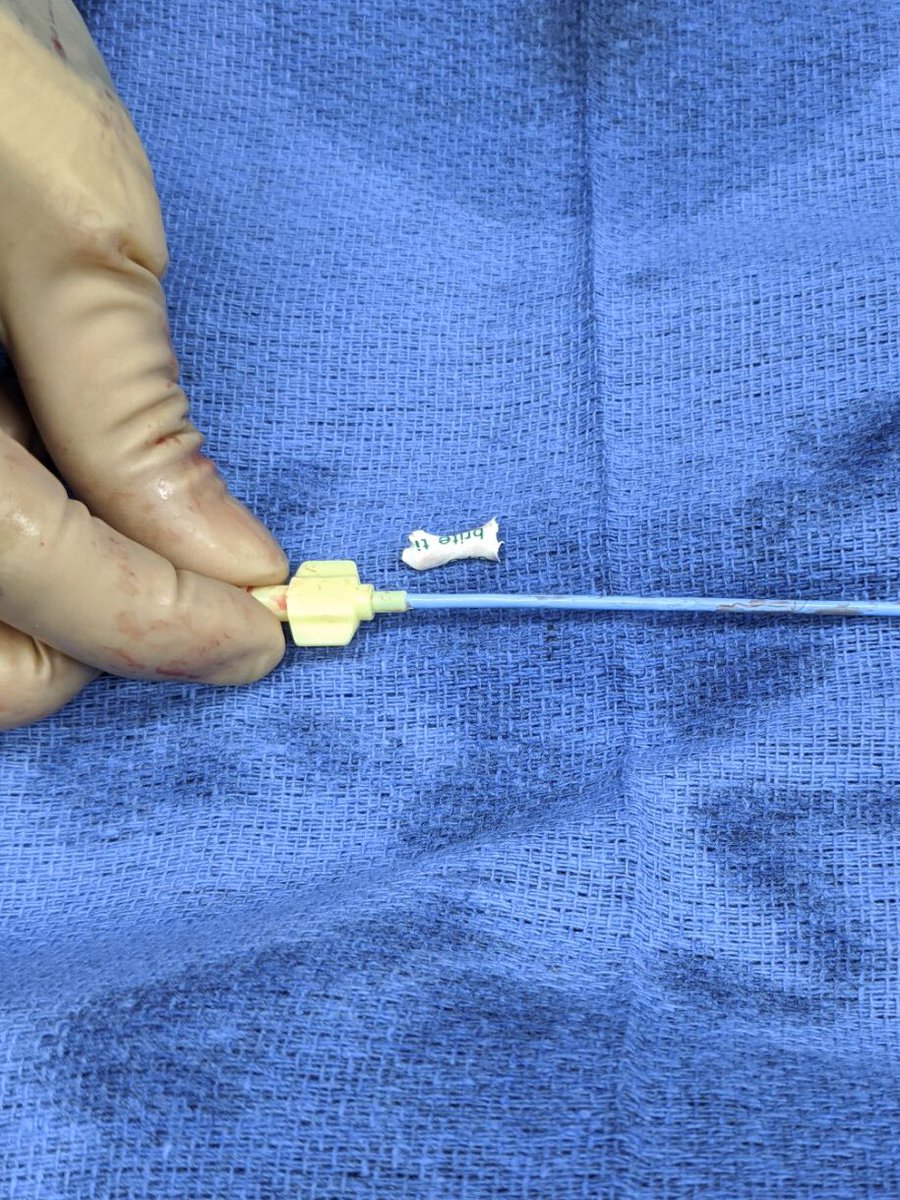 fayezsiddiquiMD's tweet image. 6’4 patient, guidecath turns out just short. Used scalpel to make an incision and peel off  cover at the prox end to get another 5-6cm which worked great! @md_SsAhmad @FahdWaqar @SabeehSiddiqui3 @chadialraies #cathlabhack #cardiotwitter