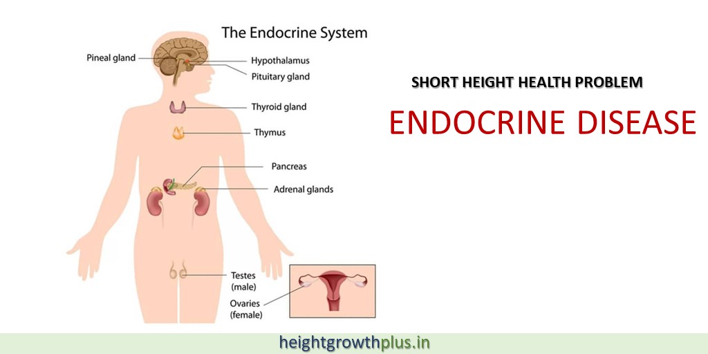 heightgrowthpl1's tweet photo. Endocrine Diseases: It affects hormone production, and height.
#heightgrowthplus #teenageengineering #HealthyLiving 
#healthyindia #healthy #fitness #fitnessmotivation #ShortyAwards #Medical #medicine #DoctorWho https://t.co/m0B55f80QN