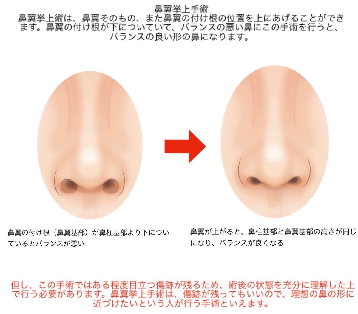 RlhEIv0lS_IYlqZ's tweet photo. 鼻翼挙上の注意まとめ。小鼻が垂れ下がると挙上するしかないよな。目立つ傷跡が残るのと鼻翼が上がるから人中が長く見える。人中やるなら挙上した後だな。この症例は鼻中隔延長もした方がよさそうだわ。 https://t.co/PbkthE18u3
