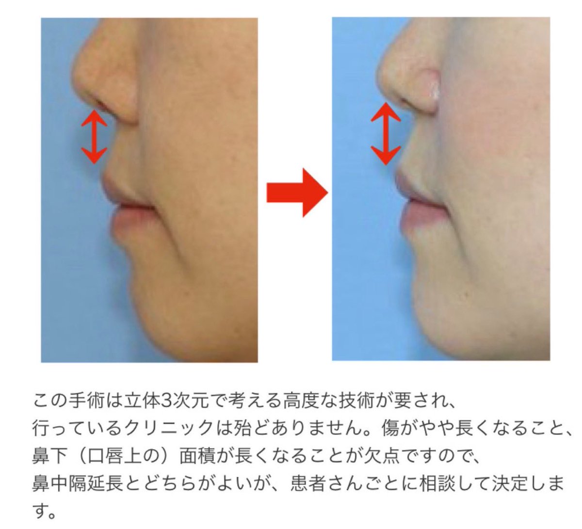 RlhEIv0lS_IYlqZ's tweet photo. 鼻翼挙上の注意まとめ。小鼻が垂れ下がると挙上するしかないよな。目立つ傷跡が残るのと鼻翼が上がるから人中が長く見える。人中やるなら挙上した後だな。この症例は鼻中隔延長もした方がよさそうだわ。 https://t.co/PbkthE18u3