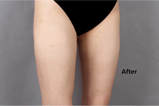365mcGlobal's tweet photo. [B &amp; A]
_______________

Surgery: Thigh Liposuction

At 365mc, doctors perform the surgery under local anesthesia. 
🔸 Procedure Link : https://t.co/qUM9bRca9W
Contact us for free consultation
🔸 Email : doctor@365mcglobal.com

#thighliposuctionkorea https://t.co/2jqVEiWTrt