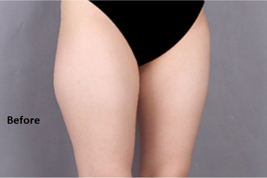 365mcGlobal's tweet photo. [B &amp; A]
_______________

Surgery: Thigh Liposuction

At 365mc, doctors perform the surgery under local anesthesia. 
🔸 Procedure Link : https://t.co/qUM9bRca9W
Contact us for free consultation
🔸 Email : doctor@365mcglobal.com

#thighliposuctionkorea https://t.co/2jqVEiWTrt