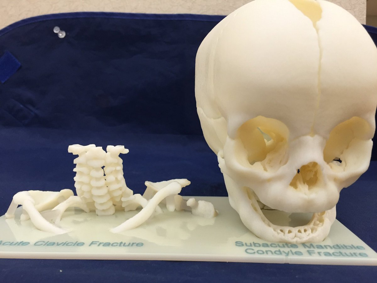 JayMorris_MD's tweet photo. The use of #3Dprinting for #Forensic #Pathology is a lesser known use for showing victim specific anatomic data. If it is easier for a #surgeon to understand #anatomy imagine the benfits to a jury/law enforcement. @MayoRadiology models are used for sentencing &amp; trials. https://t.co/xBrpc8Z4if