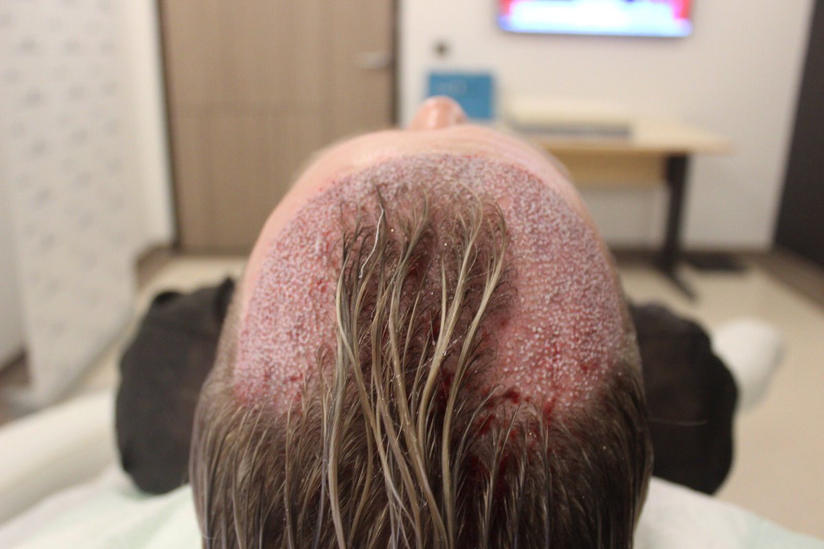 Hairavrasya Hair Transplant di Twitter: Hairavrasya Hair Transplant di Twitter: