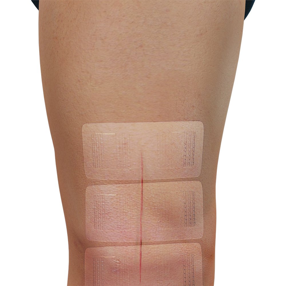 BrianColeMD's tweet photo. Dr. Brian Cole Implements New Wound Closure Innovation To Ease And Improve Healing. Read more at https://t.co/wJ6fL2acXB #briancolemd #BandGrip #skinclosure #heal #surgery https://t.co/5cGPr96uWe
