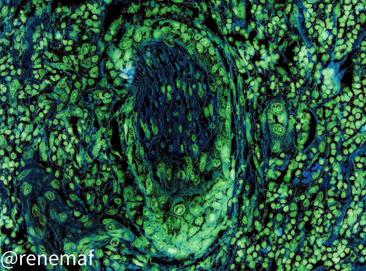 Perineural invasion in OSCC, intratumoral and minor nerves type #oralpath #OMFpath #oralcancer #pathologist #pathart