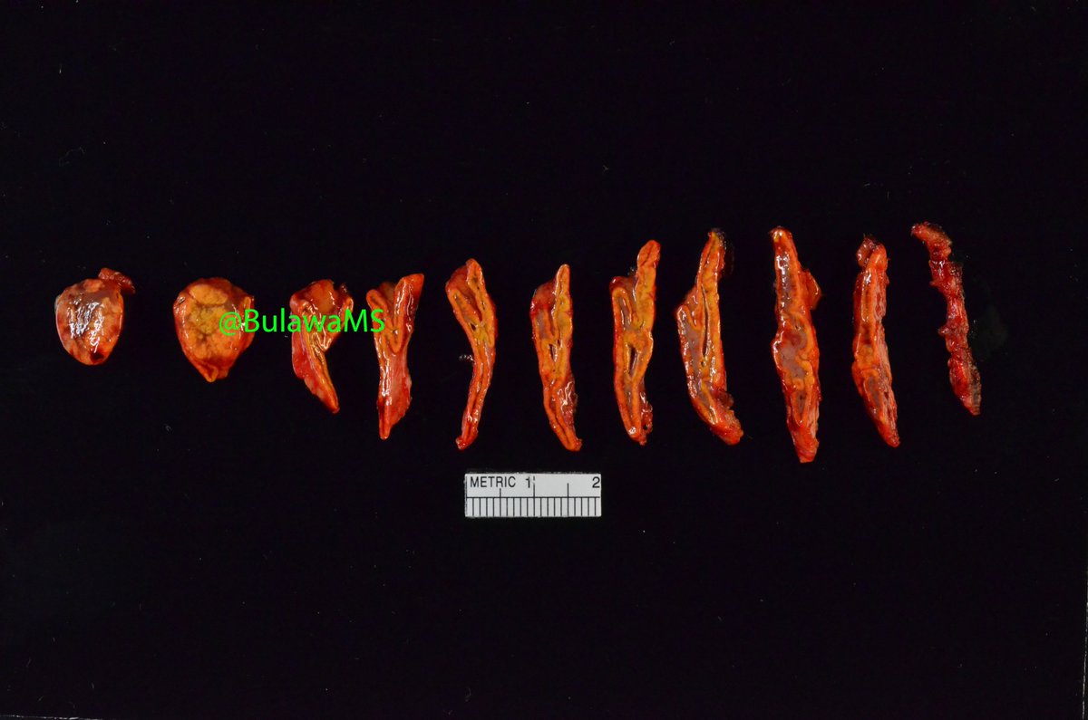 Lainee Bulawa, MS, PA (ASCP) tweet media