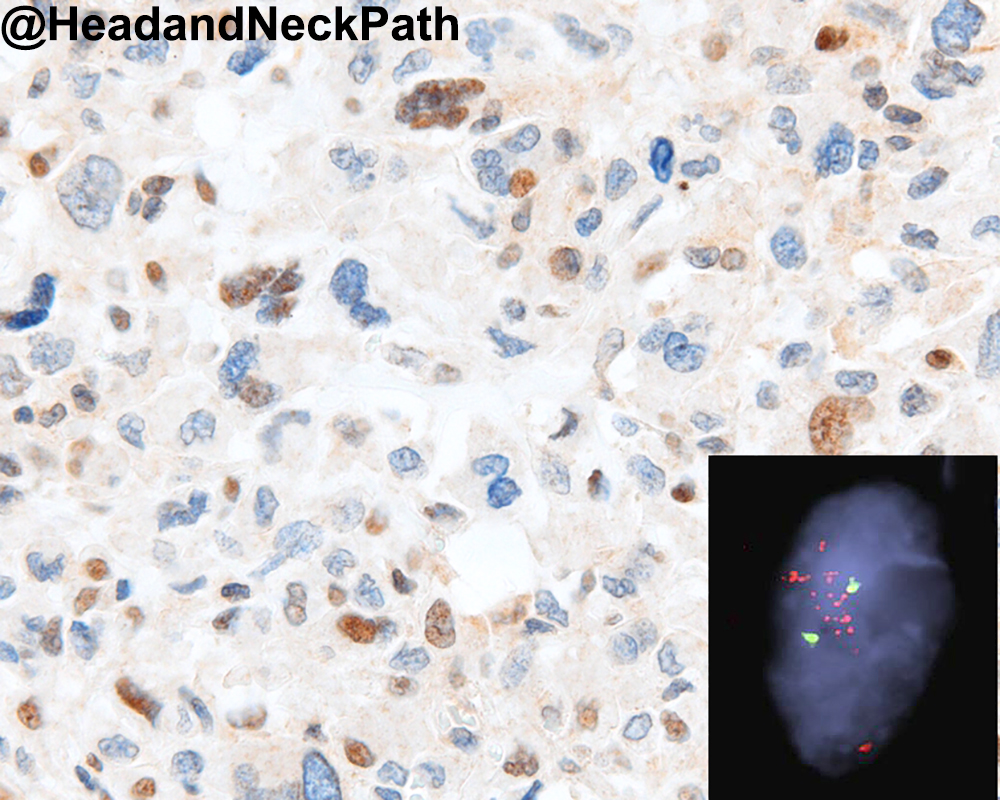HeadNeckPathol's tweet photo. The Utility of MDM2 and CDK4 Immunohistochemistry and MDM2 FISH in Craniofacial Osteosarcoma and Giant Cell Lesions
https://t.co/hvCpYBmYvI
#HeadNeckPathol #HNPJ #HeadandNeckPath #Pathology #ENTPath #PathologyTweet https://t.co/yXLpgBGt9V
