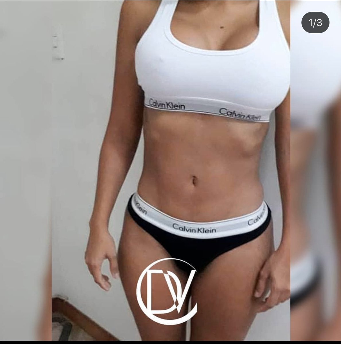 Drdevacirugiap's tweet image. ¡Testimonio❗
#LipoHD con #Mastopexia periareolar, a 2 meses de #postoperatorio
.
¿Que opinan de este resultado?⤵️
.
.
#PacientesReales #CirugiaPlastica #estetica #belleza #BellezaEsSalud #ceqe #MadeInCeqe #DrVillalobos #valencia