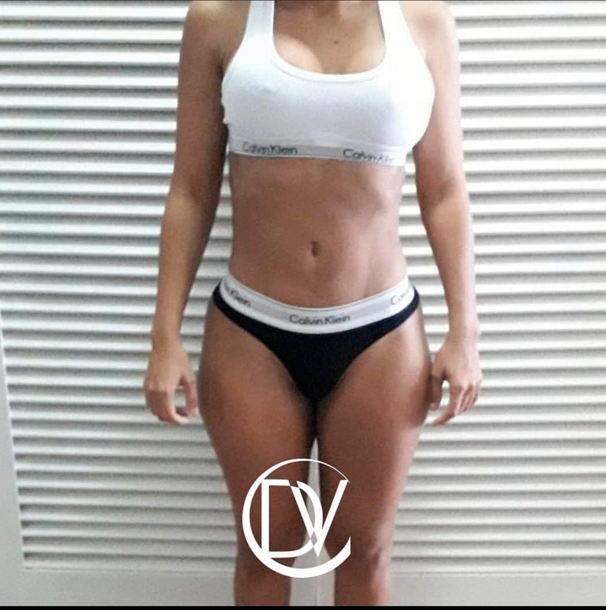 Drdevacirugiap's tweet image. ¡Testimonio❗
#LipoHD con #Mastopexia periareolar, a 2 meses de #postoperatorio
.
¿Que opinan de este resultado?⤵️
.
.
#PacientesReales #CirugiaPlastica #estetica #belleza #BellezaEsSalud #ceqe #MadeInCeqe #DrVillalobos #valencia