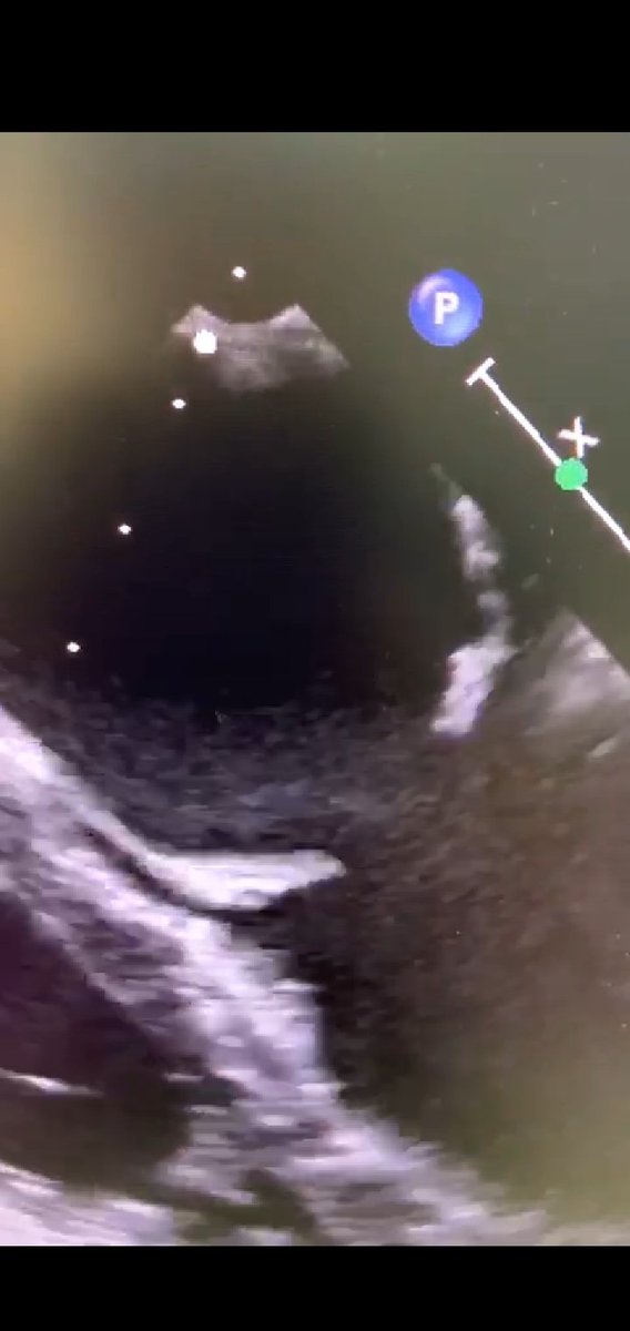 يسألنى الكثير عن ضيق الصمام الميترالي الناتج عن الحمه الروماتيزميه.. هو ضيق ناتج عن التهاب الصمام الميترالي نتيجة أصابه هذه الصمامات ببكتيريا معينه خلال الطفوله.ينتج عن الضيق كتمه فى النفس.العلاج أما جراحى او عن طريق القسطره اذا كان مناسب. هذه صور من مركزنا لعلاج مريضه بالقسطره.