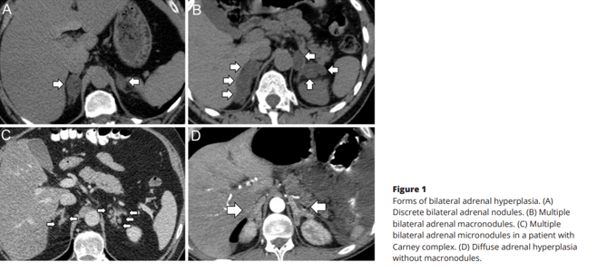 sociedadSEEN's tweet photo. Dx and management of primary BMAH
La activación de la vía cAMP / PKA se relaciona con la secreción de cortisol y el crecimiento SR
Mutaciones germinales en #ARMC5 frec.
Dx: Rx+ estudio hormonal
En casos de R aberrantes, puede existir tto médico
https://t.co/NgGjQqiNC6 https://t.co/6nSWaa1vh5
