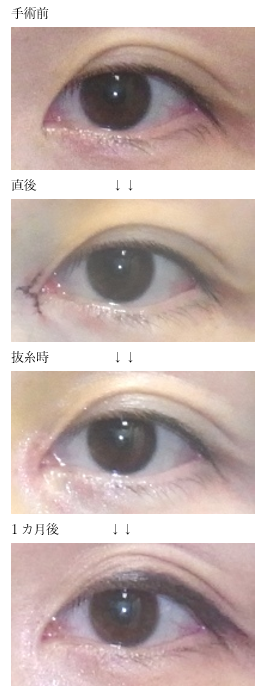 O Xrhsths 目頭の世界 Sto Twitter なんとなく目頭側の白目が小さい そこを変えたい と来院される方も増えてきました 隠れている部分が多いのが要因であることも多く 目頭切開の能力が発揮されます 目頭切開 T Co C4vvxuaasu Twitter