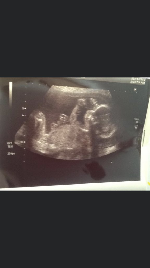 jenken88's tweet photo. Learning all about how a baby develops in science this morning and realised just how much of my pregnancy I missed! @NewmanSciDOL this was my first scan.... 16wks 5 days! #Nov2013 #ShortestPregnancyEver https://t.co/vhQRA9QQSB