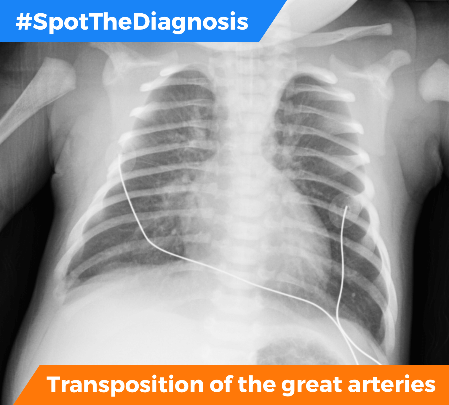 Transposition Of The Great Arteries X Ray
