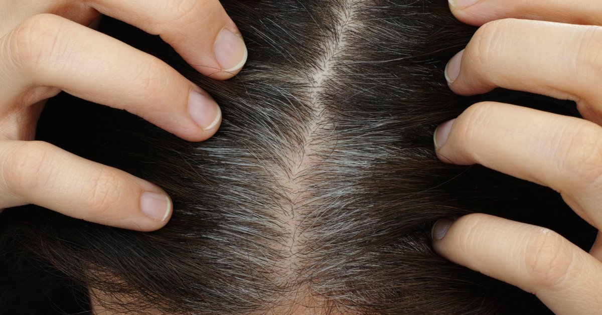 DebraPriceMD's tweet photo. I’s true, stress can turn your hair gray. #hair #greyhair #stressreduction #haircaretips https://t.co/0GfjGTHp4G https://t.co/jWO17h3yvl
