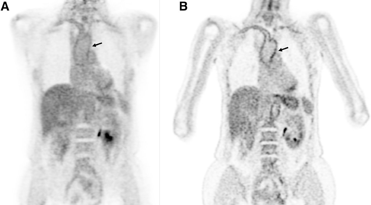 Seminars in Arthritis and Rheumatism (@seminarthrheum) on Twitter photo In the new issue:
PET scan in large vessel vasculitis. Delayed imaging at 2 hours detected more active vasculitis than at 1 hour. <a href="/KQuinnRheum/">Kaitlin Quinn</a> <a href="/petergrayson15/">Pete Grayson</a>
sciencedirect.com/science/articl… In the new issue:
PET scan in large vessel vasculitis. Delayed imaging at 2 hours detected more active vasculitis than at 1 hour. <a href="/KQuinnRheum/">Kaitlin Quinn</a> <a href="/petergrayson15/">Pete Grayson</a>
sciencedirect.com/science/articl…
