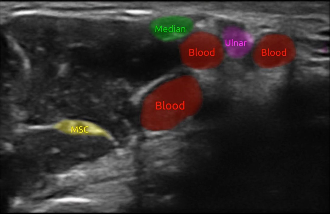 Forskningen vår med bruk av kunstig intelligens på #ultralyd vises idag frem på NRK. #AI #medisin #bildediagnostikk <a href="/SINTEFdigital/">SINTEF Digital</a> <a href="/StOlavshospital/">St. Olavs hospital</a> 
nrk.no/trondelag/snar…