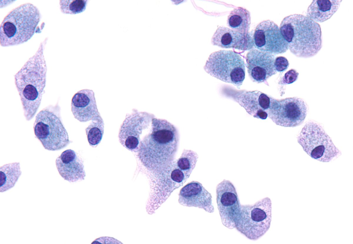 sza_jhcyto's tweet photo. "A Trickster" - Medullary Thyroid Carcinoma often assumes a very histiocytic look on LBP (especially ThinPrep), as seen here. Tips to remember - Look for plasmacytoid appearance and cytoplasmic tails favoring MTC. https://t.co/IIxsEsdWju