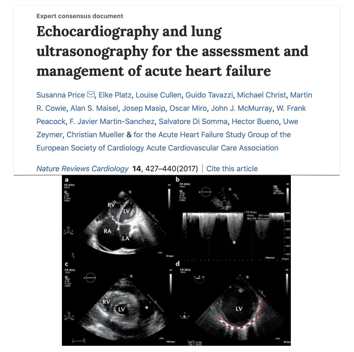 FOAMecmo's tweet photo. Cardiogenic shock? which ventricle limits CO? #POCUS scan both right/left heart (+ lung)
#echocardiography + #LUS allow for fast evaluation in acute dyspnea/hypotension, impacting on critically ills management @susannaprice #ESICMphysio https://t.co/uZmRxaQw5c #FOAMus #echofirst https://t.co/uYcmdxxpDE