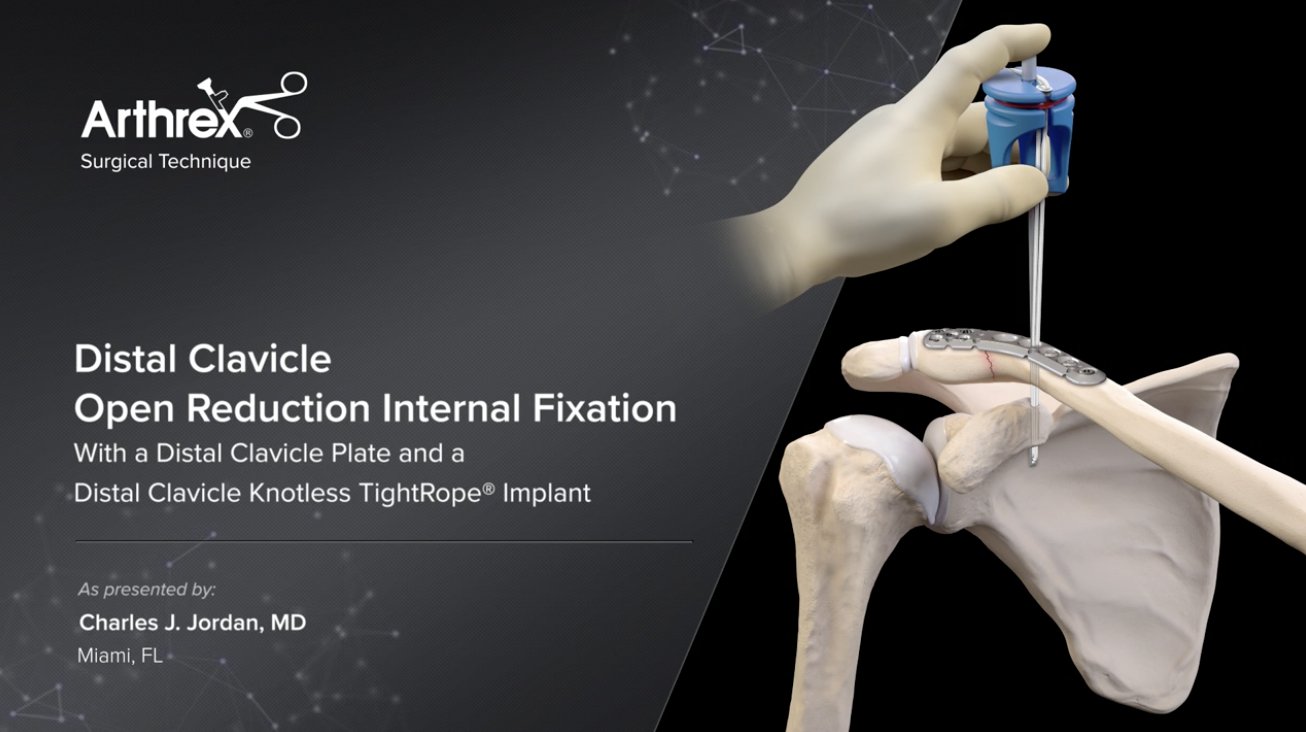 Arthrex MedEd on X: Charles J. Jordan, MD - Distal Clavicle Open Reduction  Internal Fixation With a Distal Clavicle Plate and a Distal Clavicle  Knotless TightRope® Implant    / X