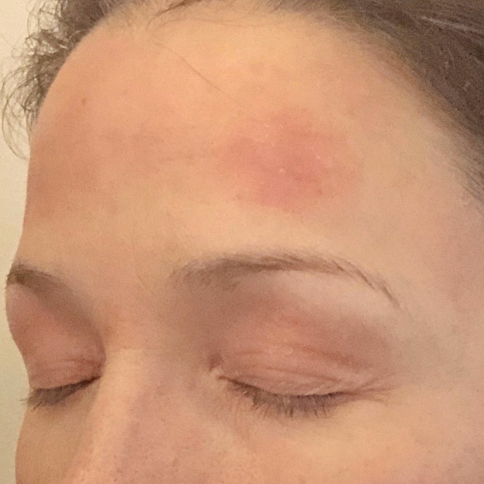 HannaSillitoe's tweet photo. Amazing to see Sarah’s progress pictures 🙏🏼😮

This is 3 weeks in, using the plan in my book Radiant for guidance + my hydrating cleanser &amp; vitamin D face cream 🌱

Flaking reduces, plaques shrink, redness fades as the body begins to heal ♥️

#psoriasis #eczema #skincare https://t.co/g6VXL1HPEp