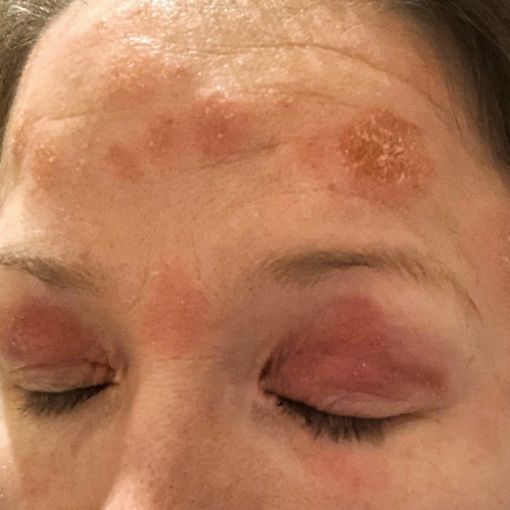 HannaSillitoe's tweet photo. Amazing to see Sarah’s progress pictures 🙏🏼😮

This is 3 weeks in, using the plan in my book Radiant for guidance + my hydrating cleanser &amp; vitamin D face cream 🌱

Flaking reduces, plaques shrink, redness fades as the body begins to heal ♥️

#psoriasis #eczema #skincare https://t.co/g6VXL1HPEp