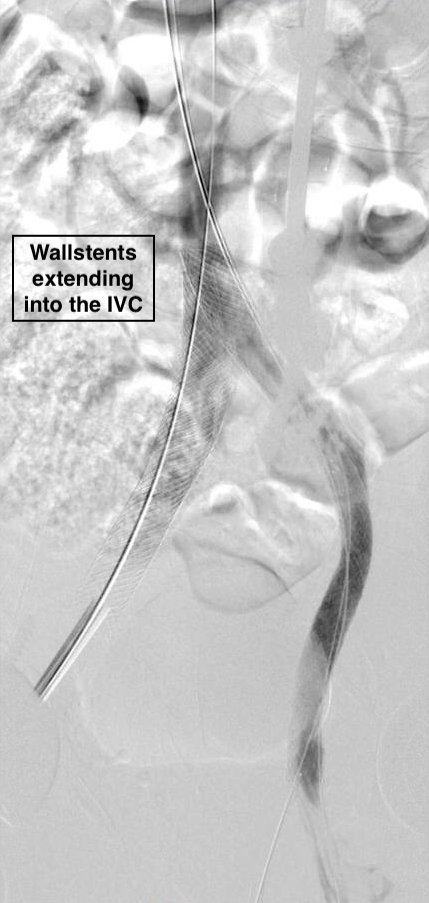 This patient had an #IVCF placed &gt;10 years ago and presented with occluded left iliac #veins and large pelvic collaterals and leg edema. The patient underwent filter retrieval and iliocaval reconstruction with wallstents. The pelvic collaterals/leg edema have resolved! #vascular