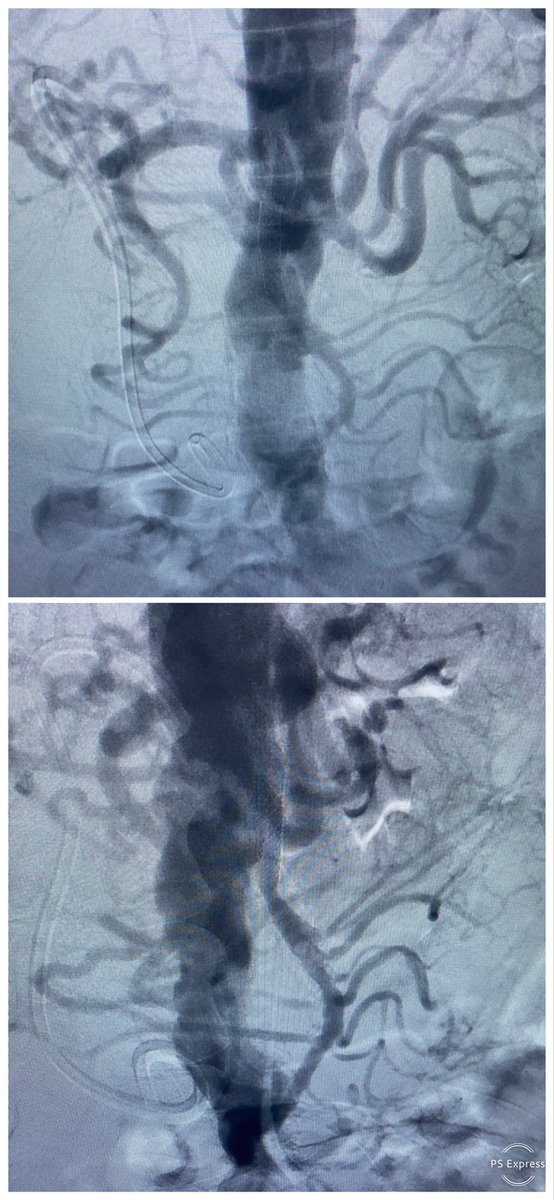Carlos Guevara MD, FSIR (@carlosguevarair) on Twitter photo Unintended weight loss, food fear, post prandial pain, SMA and IMA occlusion, radial approach SMA recan/stent, resolution of post prandial pain and increased food intake <a href="/ZagumBhatti/">Zagum Bhatti MD</a> @Saukalaka <a href="/SDhandMD/">Sabeen Dhand</a> <a href="/LessneVIR/">Mark Lessne, MD</a> <a href="/saherssabri/">Saher Sabri</a> <a href="/WashUIR/">Mallinckrodt IR</a> <a href="/JVIRmedia/">JVIR</a> <a href="/keithppereira/">Keith Pereira MD, #VIrad</a> <a href="/CHICKVIR/">Jeffrey F. B. Chick, MD, MPH</a> Unintended weight loss, food fear, post prandial pain, SMA and IMA occlusion, radial approach SMA recan/stent, resolution of post prandial pain and increased food intake <a href="/ZagumBhatti/">Zagum Bhatti MD</a> @Saukalaka <a href="/SDhandMD/">Sabeen Dhand</a> <a href="/LessneVIR/">Mark Lessne, MD</a> <a href="/saherssabri/">Saher Sabri</a> <a href="/WashUIR/">Mallinckrodt IR</a> <a href="/JVIRmedia/">JVIR</a> <a href="/keithppereira/">Keith Pereira MD, #VIrad</a> <a href="/CHICKVIR/">Jeffrey F. B. Chick, MD, MPH</a>