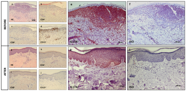 JACIInPractice's tweet photo. In Press! #Interleukin 17 as a #therapeutic target of #acute #generalized #exanthematous #pustulosis ( #AGEP) https://t.co/WwQXlTyacC https://t.co/px3sO5BTRa