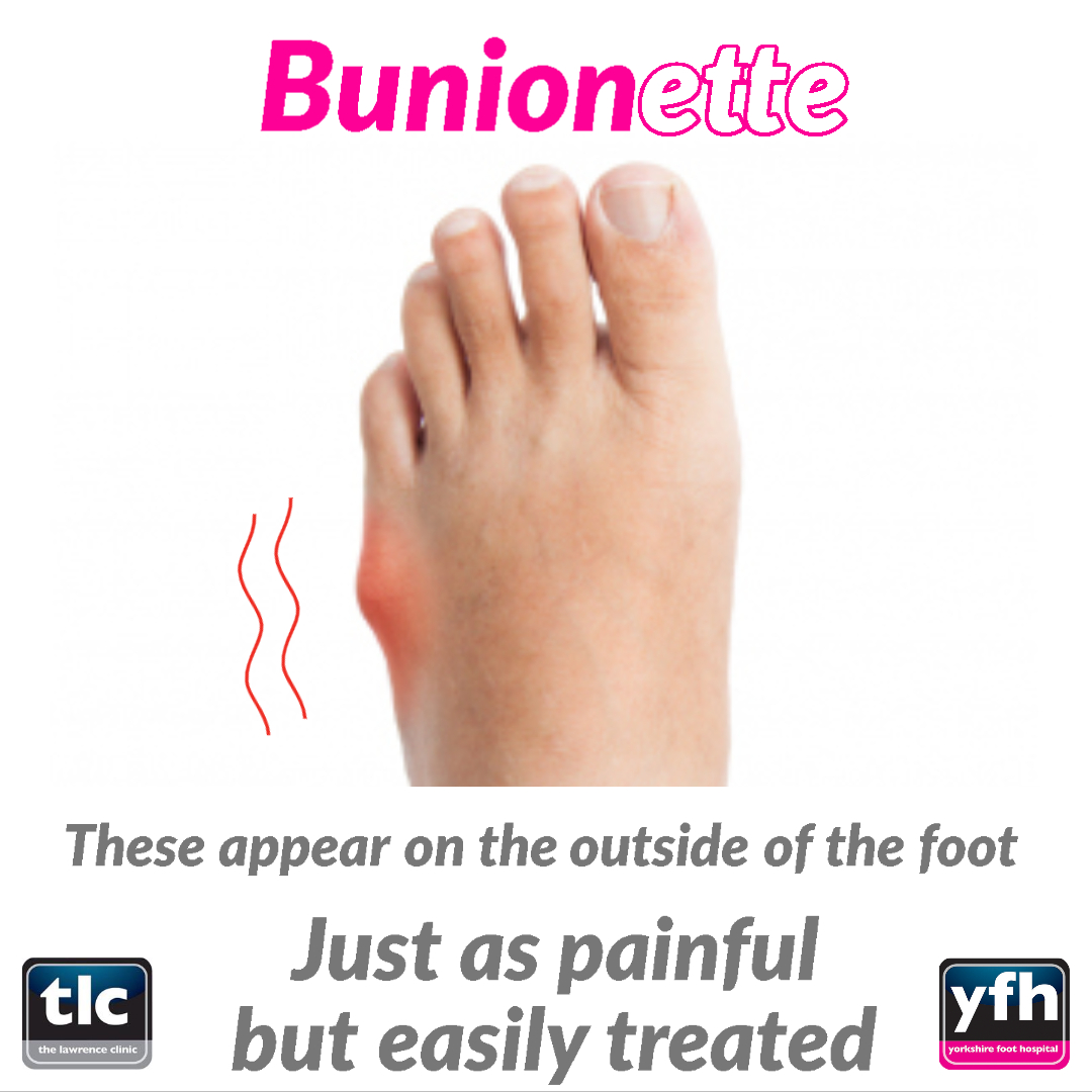 Yorkshire_Foot's tweet photo. Did you know a #Bunion  can appear on the little #toe too! This is called a #Bunionette! 👣

#footpain #footcare #plantarfasciitis #feet #foothealth #foot #podiatry #heelpain #podiatrist #flatfeet #painrelief #footpainrelief #archsupport #footproblems #bunions #toes #Leeds #YFH https://t.co/f3dfDtJxpI