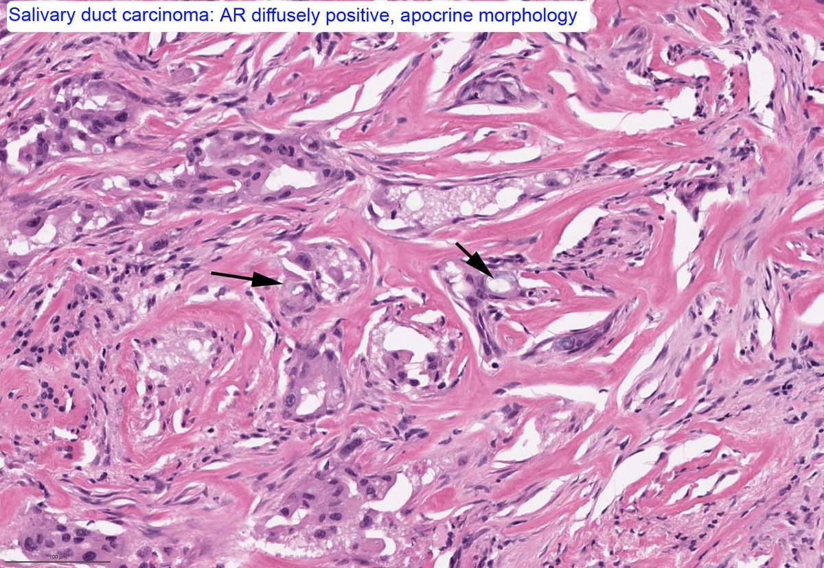 BinXu16's tweet photo. Salivary gland neoplasm 101 #ENTpath: Mucocytes does not equal to mucoepidermoid carcinoma. It can be seen in
- PA
- SC
- SDC
- Warthin
- CCC
- NUT carcinoma

Bonus: think twice when you about to diagnose HG MEC, it is probably something else. https://t.co/ZRA2c7tNBI