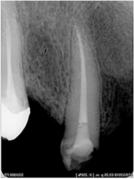 JdentoralSci's tweet photo. A Case Report on Low-Level Laser Therapy as a Coadjuvant in Sodium Hypochlorite Extrusion Management recently published.
Read full @ https://t.co/8AVCbwXlUI
#Endodontics #Oralrehabilitation #dentaltreatment #dentalcare #painmanagement #dentistry #Oralscience
#SaturdayMotivation https://t.co/3m6S4901aJ