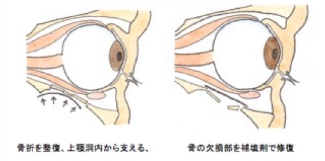 やっぱり事故の衝撃はとんでもなかったんだと思うし、眼球破裂ではなくて良かった。とにかく良くなってほしい。
#桃田賢斗  