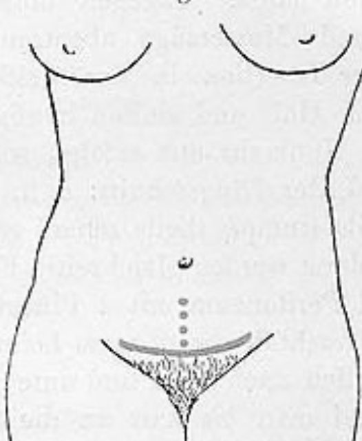 Vrouwen! De vaginale weg is de koninklijke weg. De keizersnede blijft gewoon de #nooduitgang. En, <a href="/volkskrant/">de Volkskrant</a>, de incisie loopt anders, zie de tekening. #pfannenstiel genoemd.