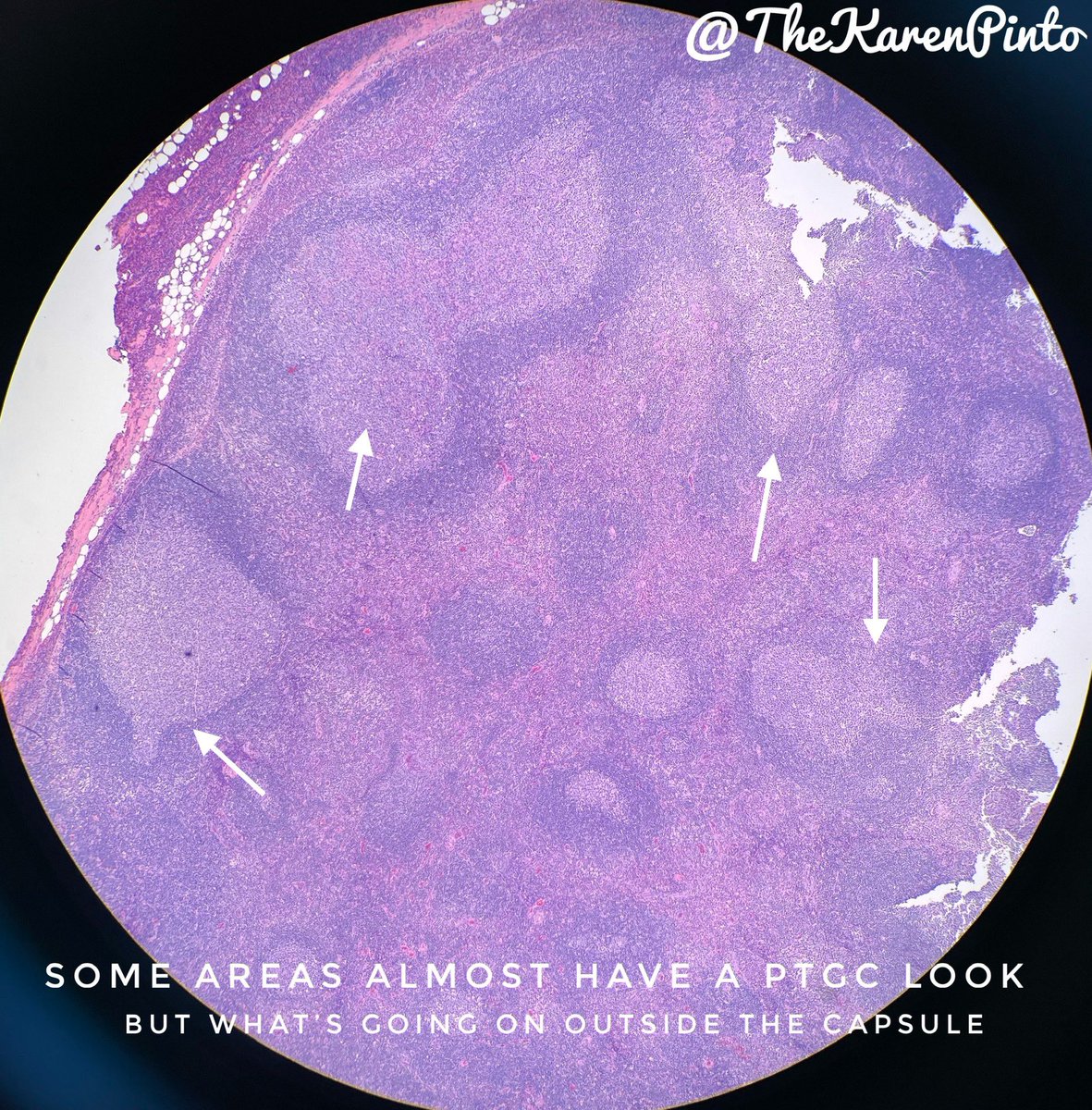 TheKarenPinto's tweet photo. 60 year old female
case of breast cancer on follow up 
presented with a 2cm neck swelling.

#pathology #lymphnode #Hemepath #pathtweetorial https://t.co/8jwpl5eDs8