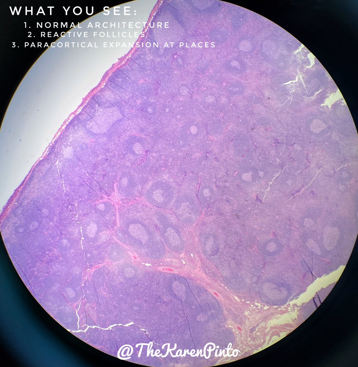 TheKarenPinto's tweet photo. 60 year old female
case of breast cancer on follow up 
presented with a 2cm neck swelling.

#pathology #lymphnode #Hemepath #pathtweetorial https://t.co/8jwpl5eDs8