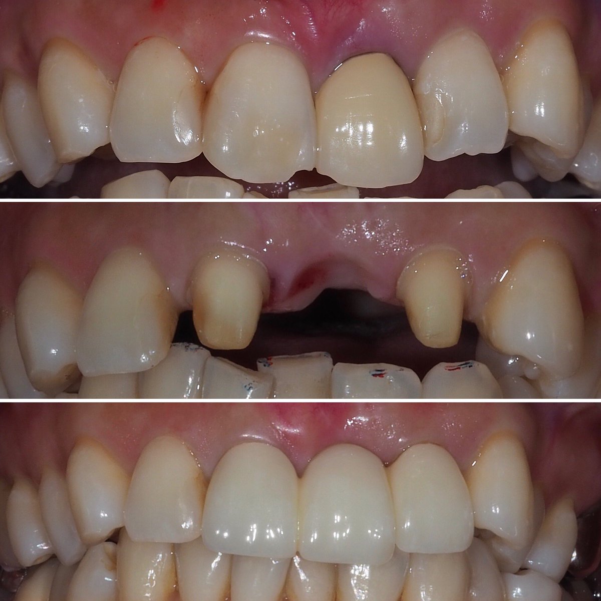 マウスピース矯正 インプラント 大阪 歯科hanaintelligence 淀屋橋 本町 歯医者 精度の高いセラミック治療をお安く ジルコニア セラミック矯正 今なら定価から 3本で Off 5本で30 Off 無料カウンセリング T Co Omigger2au セラミックで歯