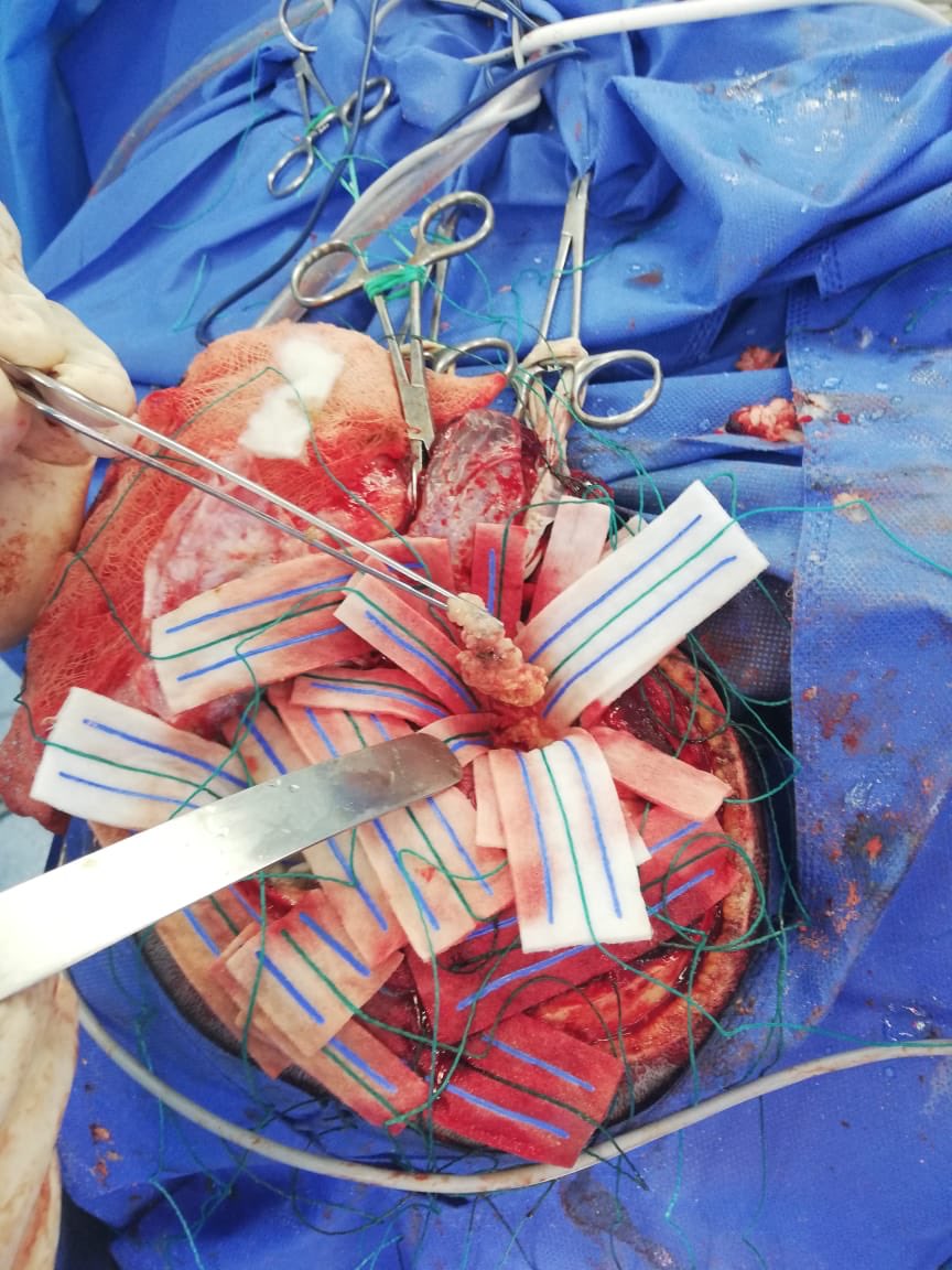 Invimedic's tweet photo. Exéresis de tumor cerebral y drenaje quístico con Neuronavegación.
👨🏻⚕️Dr. Juan Carlos Solá
👨🏻⚕️Dr. Héctor Pesantez
🏨 IESS Ceibos
#neuronavegacion #tumor #tumorcerebral #neuro #Invimedic https://t.co/YR5K3WErPv