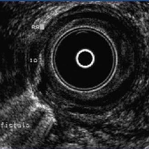 The causes of inflammation around anus.
colorectal.gr/the-causes-of-…
