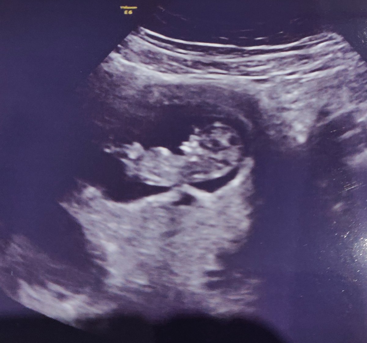daddyto3plus1's tweet image. Early scan done and relief. I've never seen a baby moving around so much on a scan. At one point she/he flipped over. #dadlife #dadsnet #3plus1